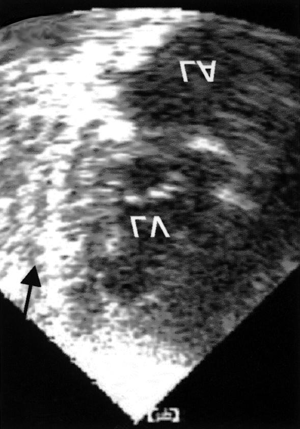 A B Fig. 2. Echocardiography. A Apical long axis view. Minimal pericardial effusion on apex and posterior pericardial space (black arrow). B Apical 4 chamber view.