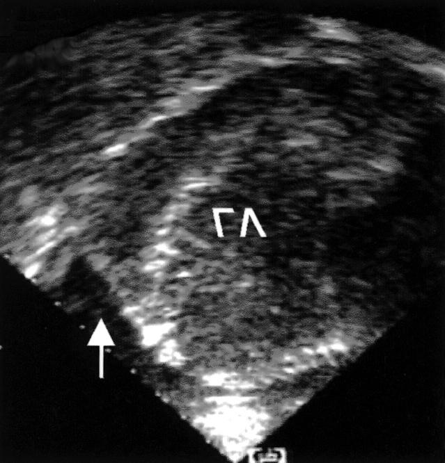 A Fig. 4. Echocardiography. A Apical long axis view. Increased pericardial effusion on apex and posterior pericardial space (white arrow). B Apical 4 chamber view.