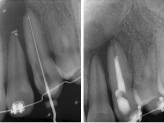 해당치아는자가이식 2년후까지임상적및방사선사진상에서병적소견없이성공적으로유지되고있다 (Fig. 9). Fig. 5. Pretreatment panoramic radiograph and 3D dental CT.