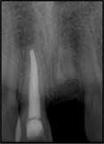 infrpositioned tooth out 2 mm() nd the ffected tooth ws