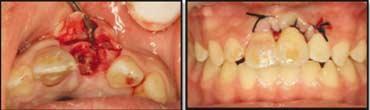 Fig. 12. 4Y 6m follow-up: The root of mxillry left centrl incisor continued to resor. Fig. 13, 13.