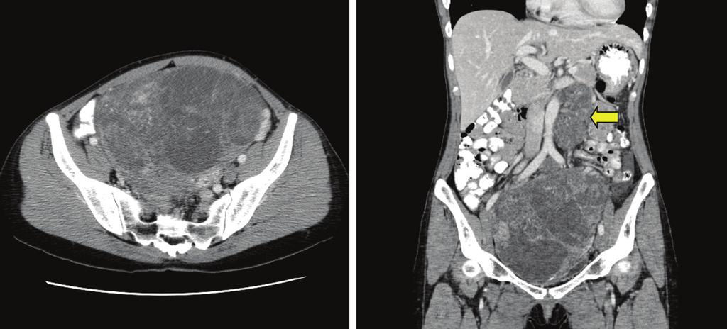 KJOG Vol. 54, No. 11, 2011 Fig. 1. Findings of abdominopelvic computed tomography. A huge (18 17 14 cm) solid and multi-septated cystic mass occupies the pelvic cavity.