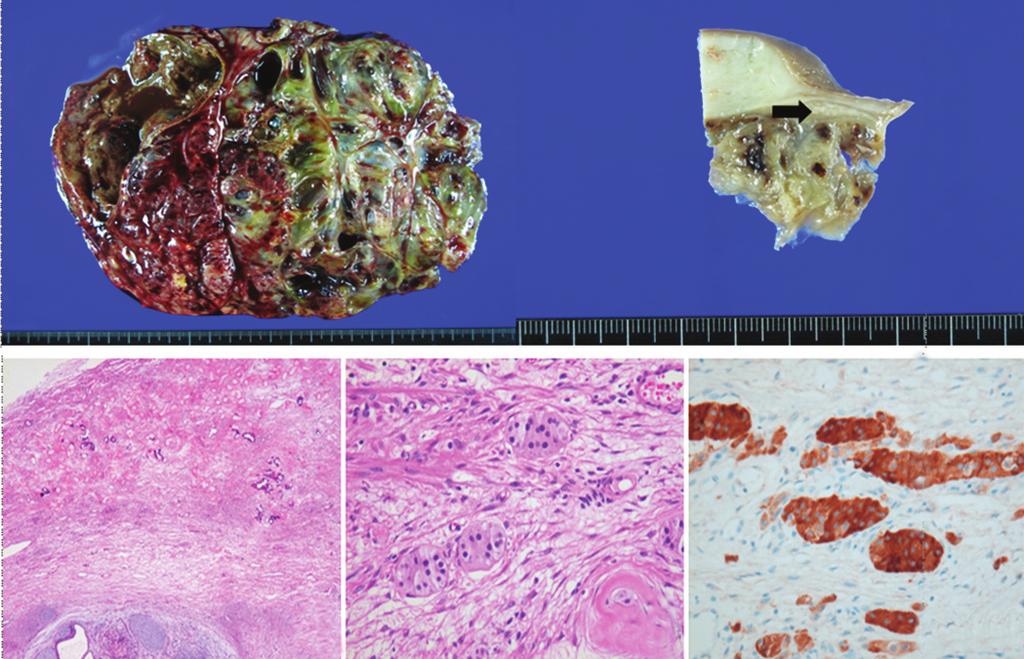 Kyung-Hee Lee, et al. Complete androgen insensitivity syndrome with malignant mixed germ cell tumors A B C D E F G H I J K Fig. 2. Gross findings of pelvic mass.