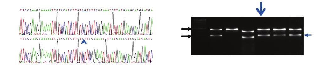 KJOG Vol. 54, No. 11, 2011 Partial seq. of AR gene Normal Patient NAIP e4 SRY MC FC - Pt - -.Arg615del) Fig. 3. The results of molecular analyses.