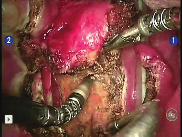 수술후 6개월째추적관찰중이며종양의재발이의심되는소견은없고수술또는방사선치료로인한특이합병증은발생하지않은상태이다. 고 찰 Fig. 4. Then, dissection was done at buccal mucosa area.