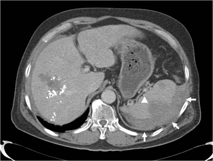 김금하외 9 인. 자연파열을동반한간의원발상피모양혈관내피종 1 예 Figure 4. Follow-up dynamic CT scan after 3 months of transarterial chemoembolization.