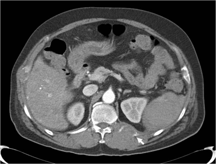 () heterogeneously enhanced soft-tissue mass is evident at the costovertebral junction of the left 12 th rib (arrows).