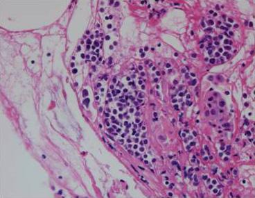 and eosin staining, 200), (B) A higher magnification of tumor cells revealed eccentric