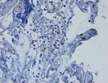 Immunohistochemically, the atypical cells were positive for (C) myeloperoxidase (
