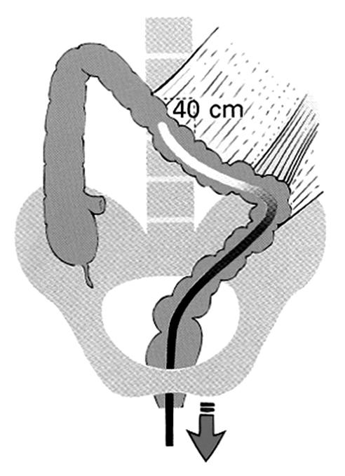 The Korean Journal of Gastrointestinal Endoscopy Room A 만곡부와말단회장부삽입 은창수 한양대학교의과대학내과학교실 Colonoscopic Insertion through Flexures and Terminal Ileum Chang Soo Eun, M.D.