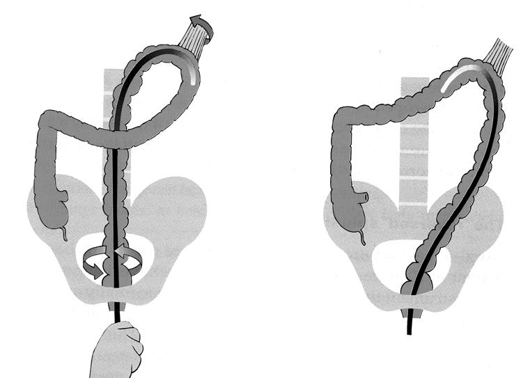Figure 3. Persistent descending mesocolon. Anti-clockwise rotation swings a mobile colon back to a normal position. Figure 4.