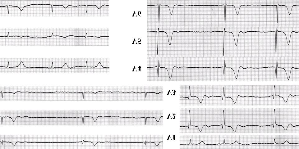 The ECG shows atrial fibrillation with a slow ventricular response about 42 beats/minute which required a VV pacemaker. ECG:electrocardiography. Fig. 3.