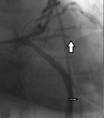 - Byoungmoo Lee, et al. Myocardial infarction during Marathon - 관상동맥조영검사 : 관상동맥조영술에서좌전하행지중간부에 90% 이상의협착에혈전이동반되어있었으며 thrombolysis in myocardial infarction (TIMI) grade III flow가관찰되었다.