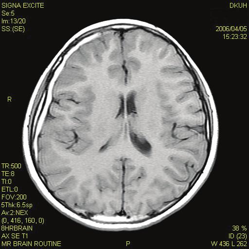 The patient s transverse brain MRI section shows subacute subdural hemorrhage in the frontal, temporal and parietal lobes.