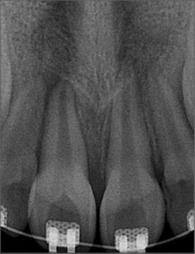 loss for eruption of upper right centrl incisor, () showing open root
