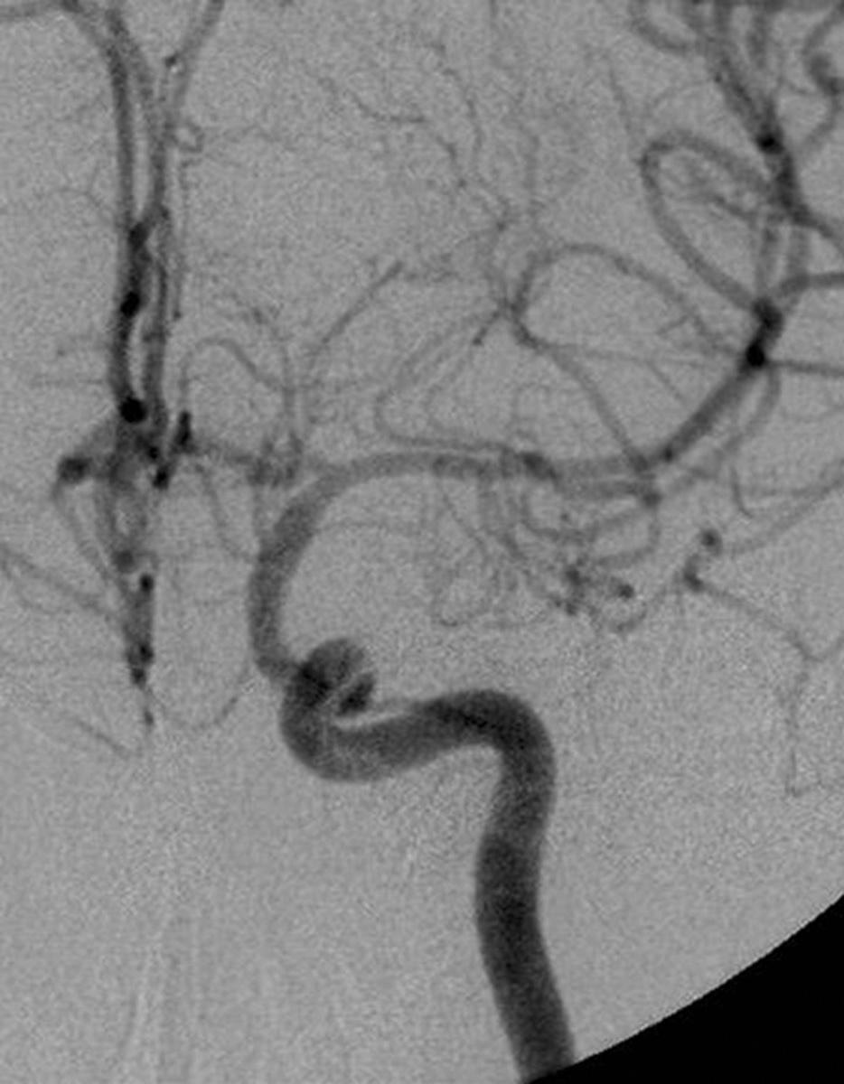 Lateral angiogram of the left ICA shows severe stenosis (>70%) (arrow) of the supraclinoid portion. B.