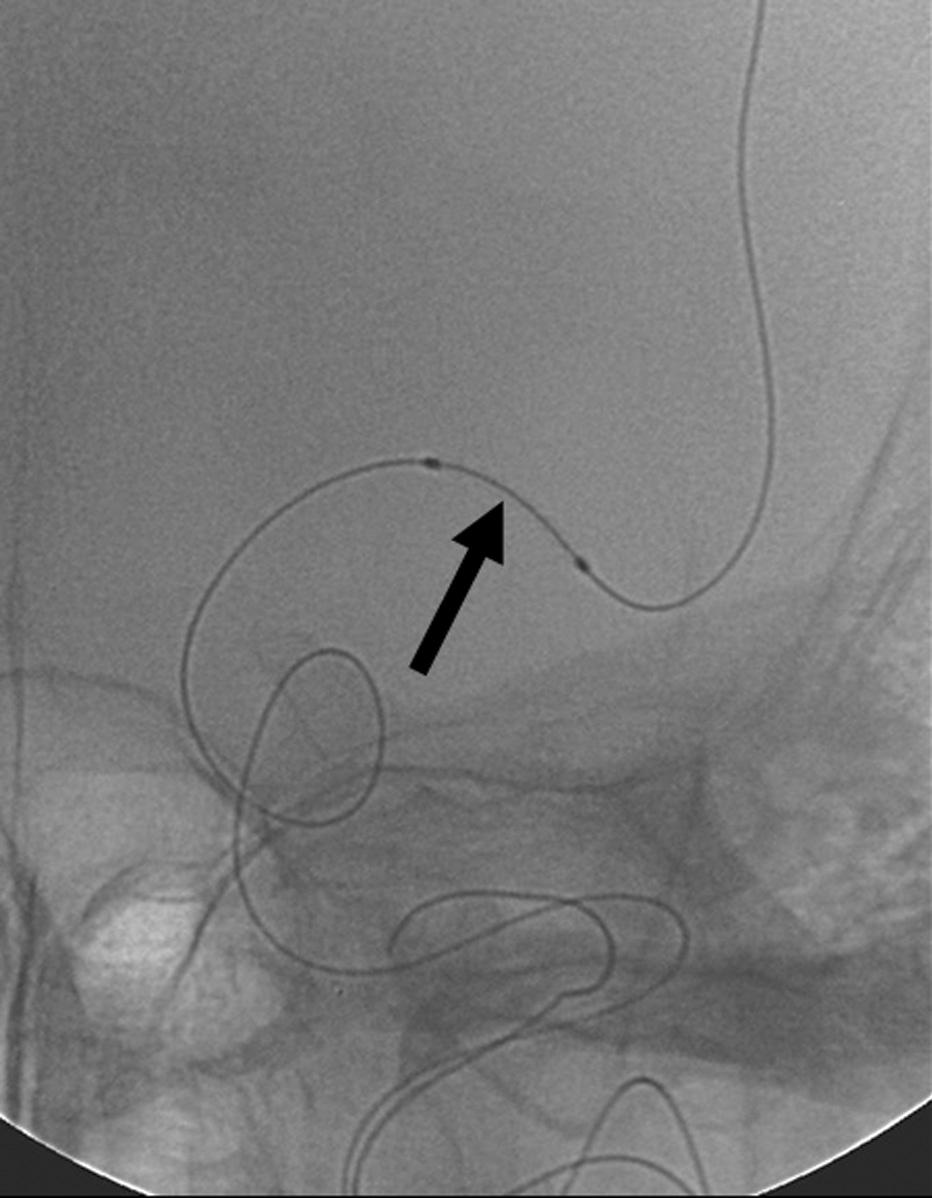 artery. B. Lateral angiogram of the left ICA demonstrates marked tortuousity of the ICA. C.
