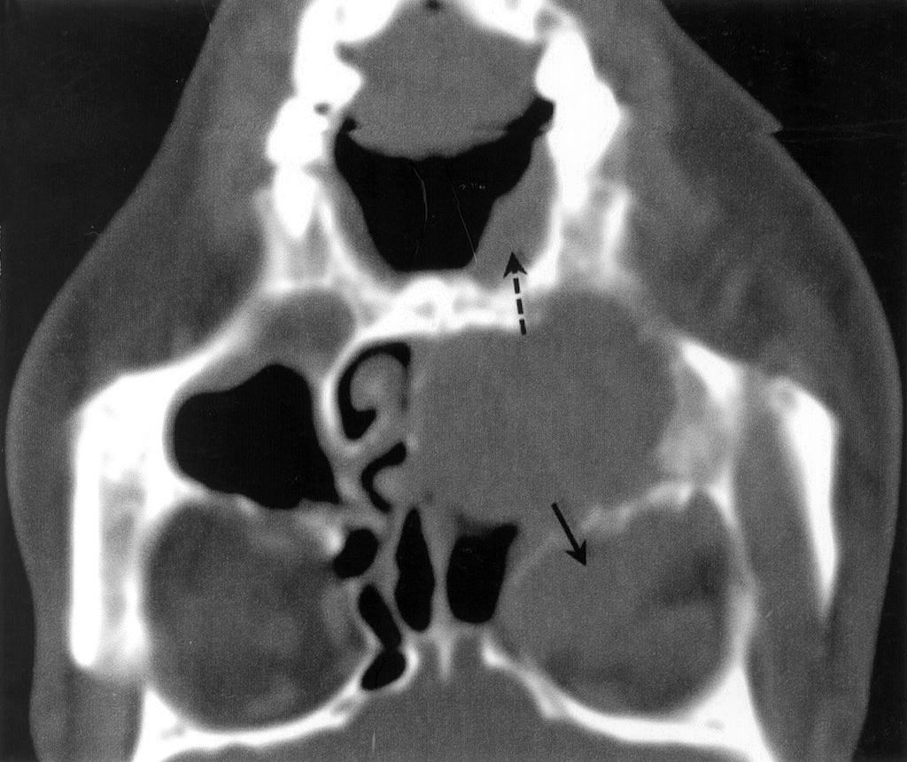 This mass destructed the posterior wall of left maxillary sinus and extended to the infratemporal fossa (solid arrow) and made left pterygopalatine fossa widening (dash