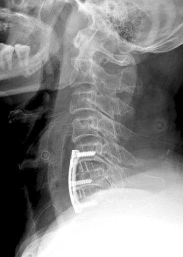 (B) Post-trauma 1 week C-spine lateral radiograph shows the decrease of prevertebral soft tissue shadow compare to initial
