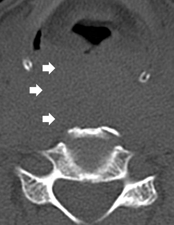 (C) Immediate post-operative C-spine lateral radiograph showed marked decrease of prevertebral soft tissue shadow and anterior