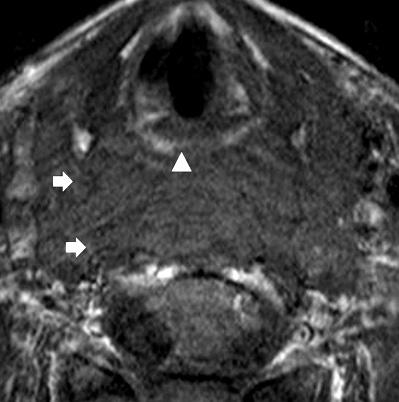 head) by extensive hematoma in the prevertebral space (arrows) from C1 to T4, the tear of anterior longitudinal ligament and longus coli muscle, disc