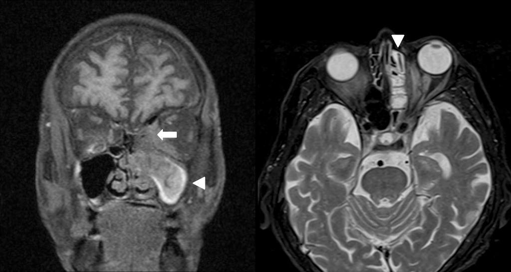 - 김성일 외 : 동안신경마비를 동반한 안와 국균증 - A B Figure 4. Brain magnetic resonance imaging at initial visit.