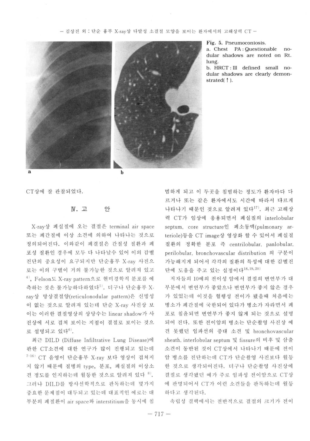 - 김상진외 : 단순흉부 X- r y 상다발성소결칠모양을보이는환자에서의고해상력 CT - Fig. 5. Pneumoconiosis. Chest PA : Qu estionle no dulr shdows re noted on Rt lung HRCT: III defined smll no dulr shd ows re clerly demonstrted( ).