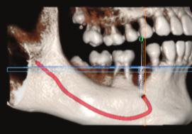 Fig. 3. 하악관의 주행 및 이공의 위치.