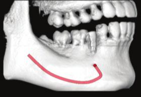 수술 술식 병증은 없었다. 준비한 수술형판으로 Guide drilling을 시행하고 (Fig. 5) 2mm dirlling 후 식립방향을 확인하였다.(Fig. 5-).