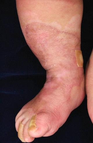Large sized skin defect at the extensor side of the right leg.