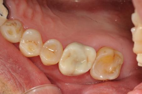 Replica technique procedure to measure the internal fit of monolithic zirconia crown.