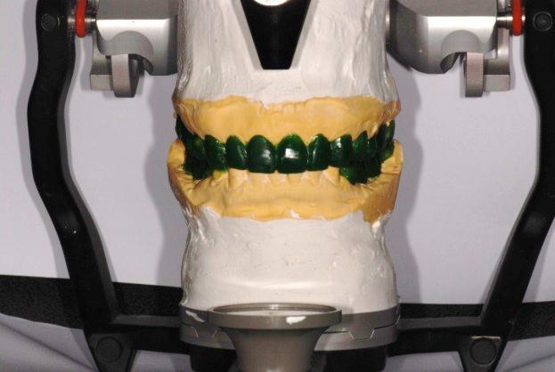 진단 납형 을 통해 형성된 치아의 형태를 치과용 putty (Express STD Putty, 3M ESPE, US)로 복제하여 간접법으로 임시 수복물을