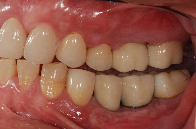 remaining molars restored with monolithic zirconia restorations. Fig. 9.