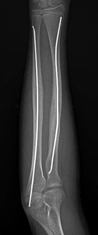 7 mm 압박 금속판, 1/3 tubular plate를 이용할 수 있으며, 경우에 따라서는 4개의 나사못 고정으로 충분히