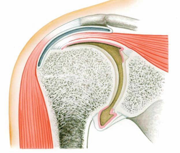 정적안정화기구와관련된인대등 어깨뼈봉우리 ( 견봉 ) acromion 윤활액주머니 ( 활액낭 ) synovial bursa 가시위근육힘줄 ( 극상근건 ) supraspinatus tendon 가시위근 ( 극상근 ) supraspinatus muscle 제 1 장 어깨세모근 ( 삼각근 ) deltoid muscle 위팔뼈 ( 상완근 ) humerus