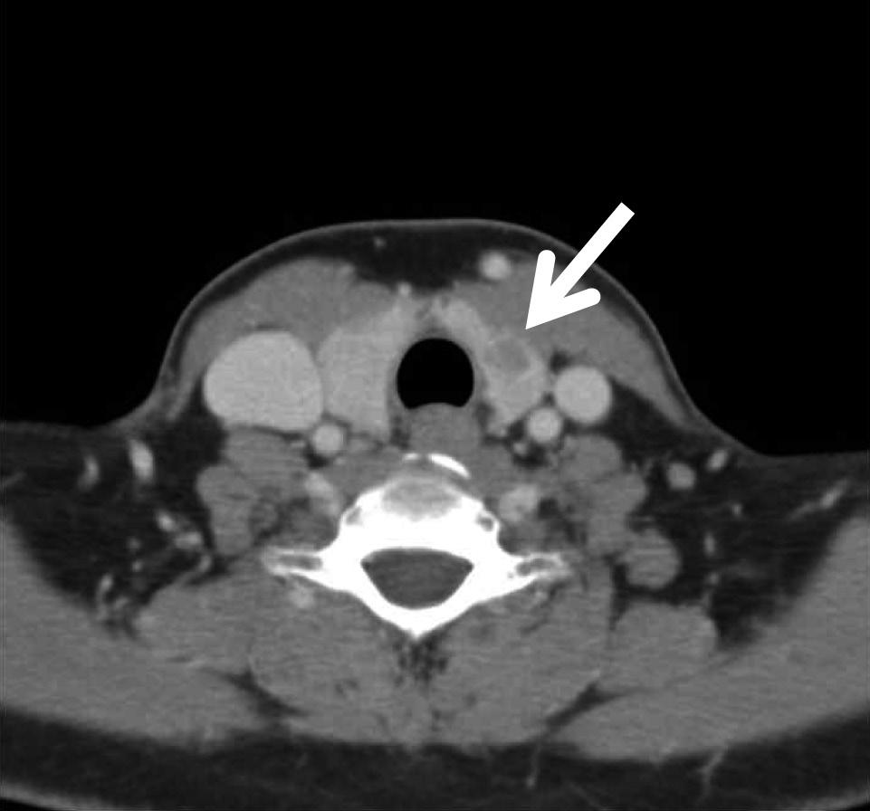 nd post-radiotherapy T image of same area ( and, arrow). Fig.