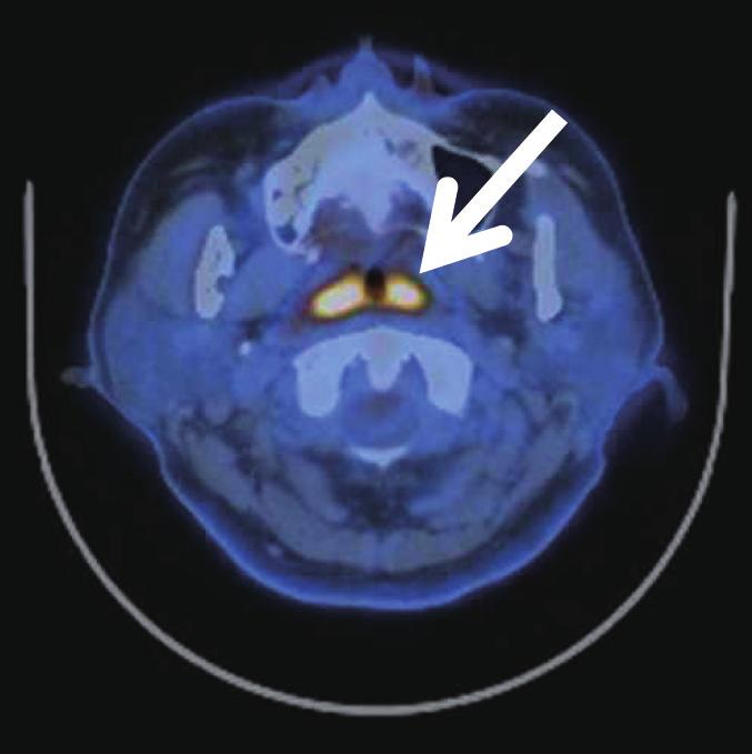 Korean J Otorhinolaryngol-Head Neck Surg 2017;60(11):579-83 Fig. 4. PET T. iffuse swelling with increased FG uptake in bilateral nasopharynx (, arrow) and left thyroid gland (, arrow).