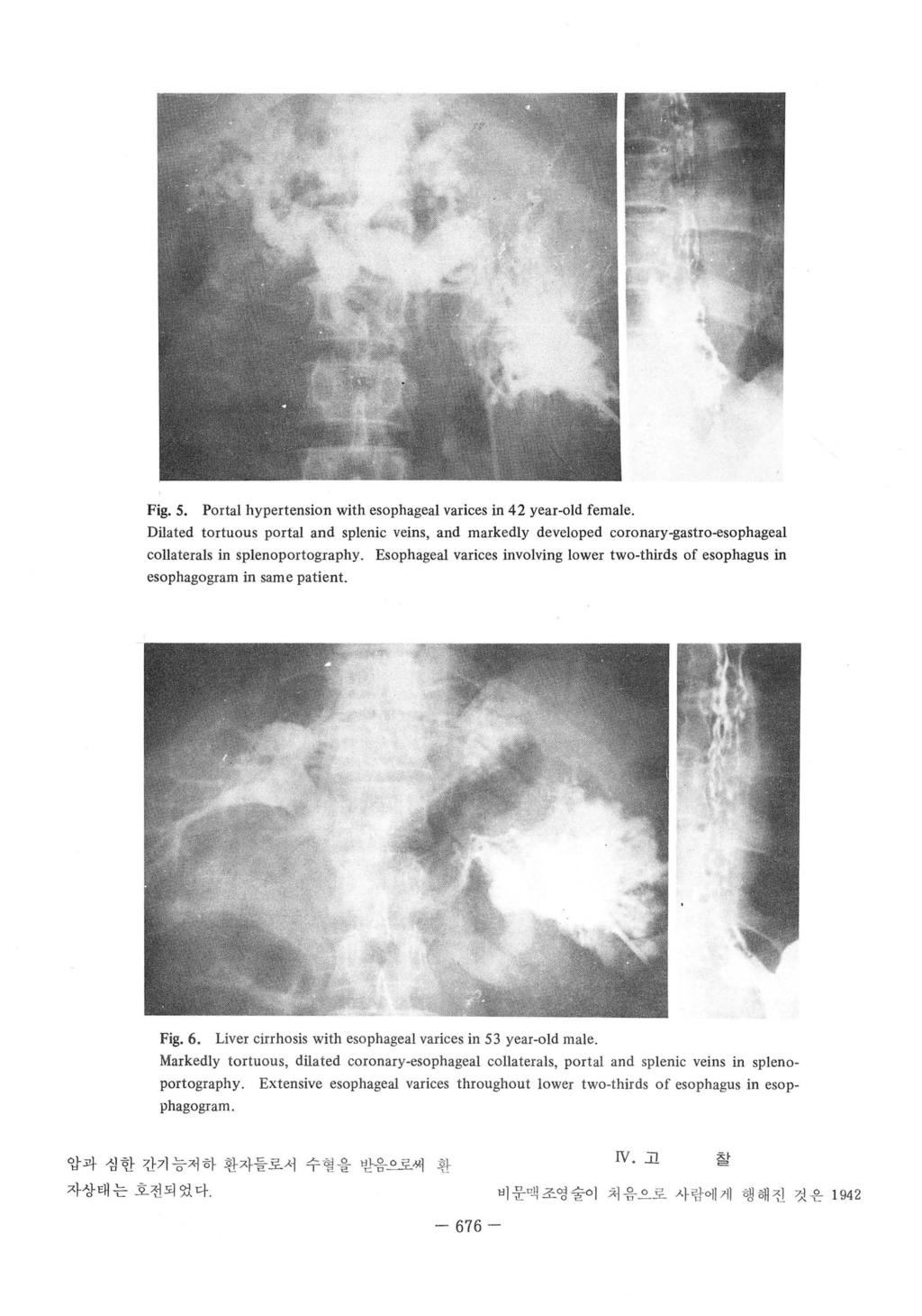 Fig. S. Portal hypertension with esophageal varices in 4 year-old female. Dilated tortuous portal and splenic veins, and markedly developed coronary-gastro-esophageal collaterals in splenoportography.