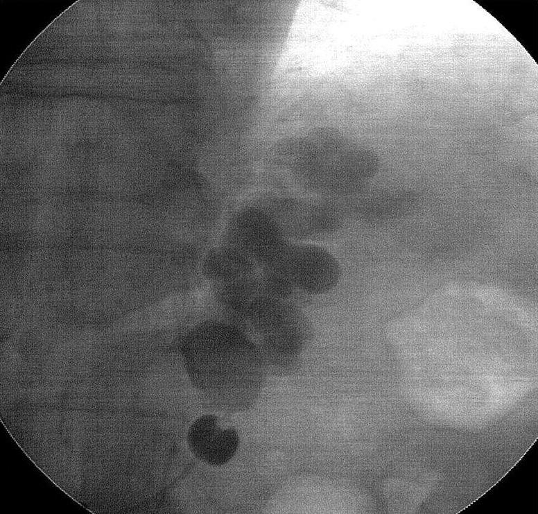 Balloon-occluded left renal venogram reveals partial contrast filling in the gastric varices with small-sized collateral veins (Hirota grade 3, Kiyosue type B1). C.