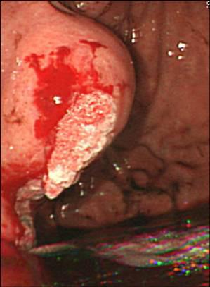 - Chang Jin Yea, et al. Adrenal abscess after N-butyl-2-cyanoacrylate injection - Figure 1.