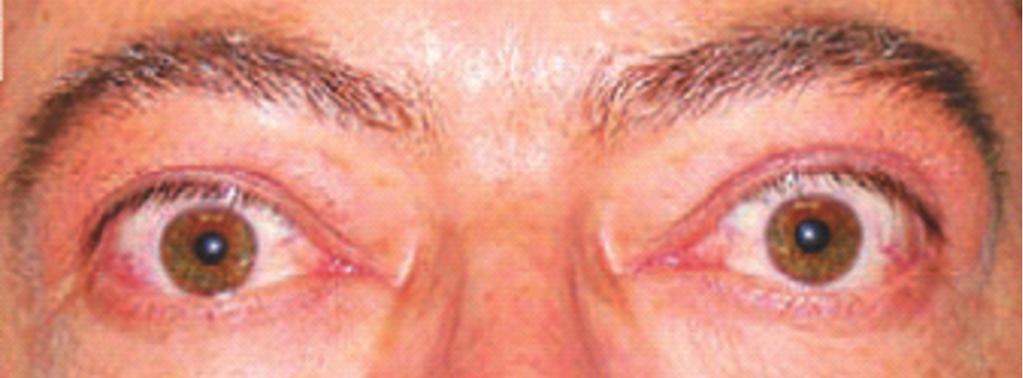 Jeong SH Disorders of the Eyelid 께눈꺼풀처짐이호전된다. 3번뇌신경마비 3번뇌신경마비로눈꺼풀처짐이발생하는경우에는항상안구운동마비도발생하며, 동공도확대될수있다. 핵병변인경우양측눈꺼풀처짐이발생한다. 눈뜨기행위상실증 (Apraxia of Eyelid opening) 눈뜨기행위상실증은눈을뜨지못하나눈꺼풀올림근기능이상으로설명되지않는경우이다.