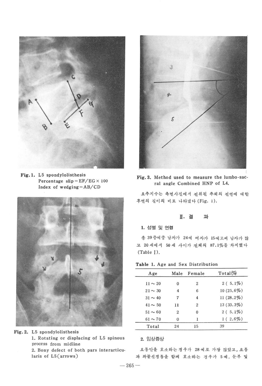 3 F \K,ι 5 Fig. l. L5 spondylolisthesis Percentage slip = EF/EG x 100 lndex of wedging =AB/CD Fig.3. Method used to measure the lurnbo-sacral angle Cornbined HNP of L4.