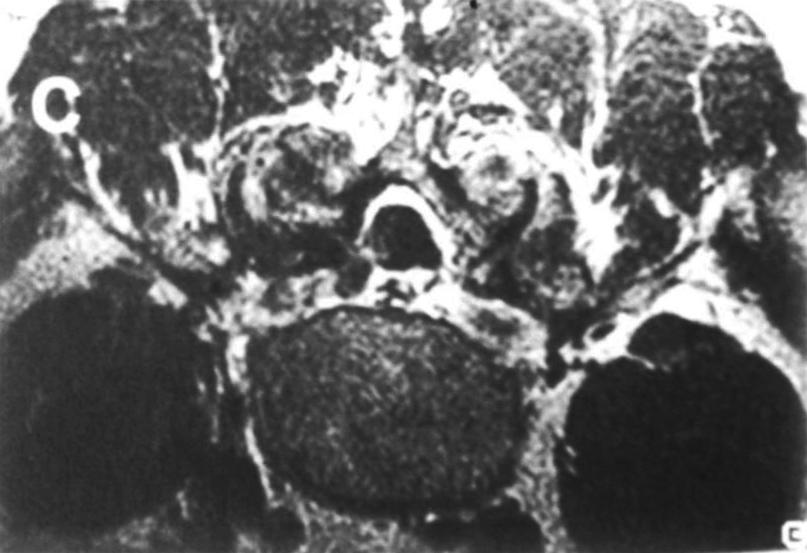 T2-weighted image(). There is a enhancement around cystic mass with Gd-DTP(). Fig. 4.