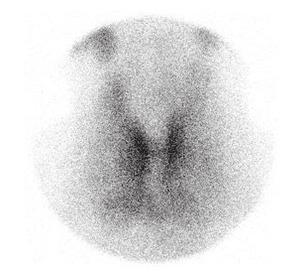 74 Kim SM, et al. Fig. 3. 99m Tc O4 thyroid scan shows diffuse enlarged thyroid with inhomogenous uptake. Uptake, 3.5%.