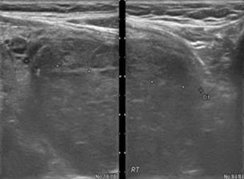 Incidental Detection of Struma Ovarii on the Whole Body Scan in a Differentiated Thyroid Cancer Patient 용한다. 갑상선조직을포함하는난소종양은전신스캔에서위양성요오드섭취를보일수있다.
