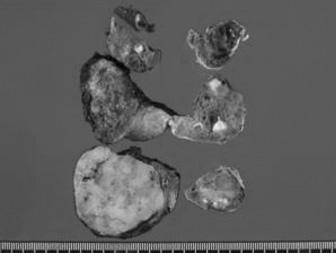 현미경적검사에서우엽의결절은피막형비침윤성의소포변이유두암 (follicular variant papillary thyroid carcinoma) 의소견을보였으며, 좌엽의결절은피막형침윤성의소포 Fig. 1. Representative radiologic and pathologic images of the thyroid cancer.