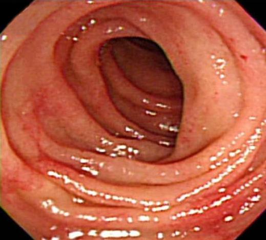 4), 추적상부위장관내시경에서도일부의발적과충혈된점막만관찰 Figure 3. fter hematemesis.