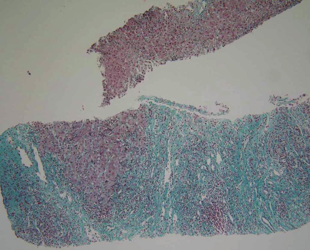 40). Figure 3. The overall architecture is distorted by extensive fibrotic septa (Reticulin stain, 200).
