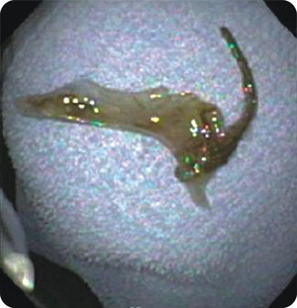 Sang-Ho Lee, et al: Foreign bodies, Esophageal perforation, Mediastinitis Fig. 3. A fish bone, approximately 1.5 cm in length, was removed from the esophagus. Fig. 4.