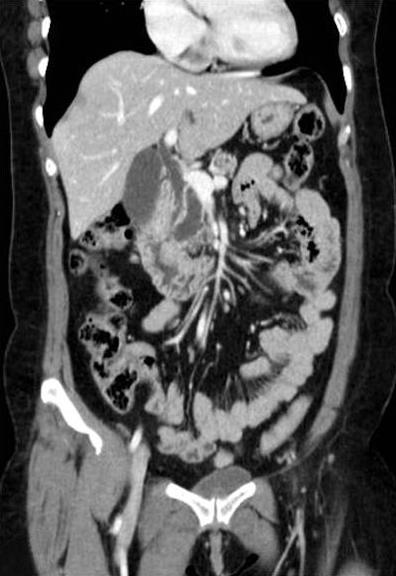 (B) In 2008, main pancreatic duct was more dilatated and the solid nodule is more enlarged compared to previous CT scan.